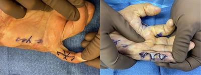 Concepts in soft-tissue reconstruction of the contracted hand and upper extremity after burn injury